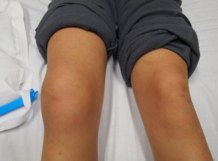 Déformation de l'articulation du genou avec arthrose