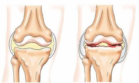 Articulation du genou saine et arthritique